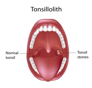 Tonsilloliths - Kids Discover