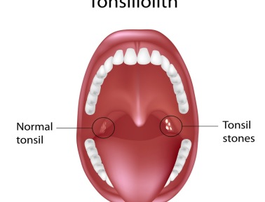Tonsil Stones Stink