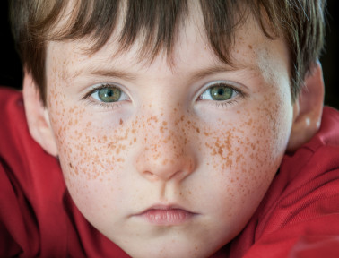 What Causes Fabulous Freckles?